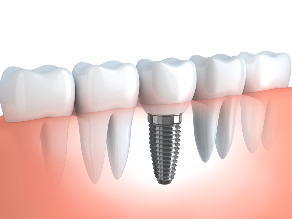 dental-implants-coconut-grove-smiles-fl