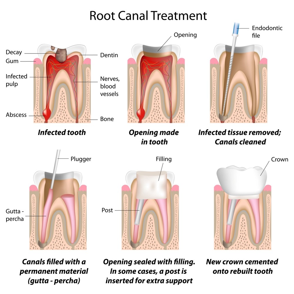 root-canal-miami-fl-coconut-grove