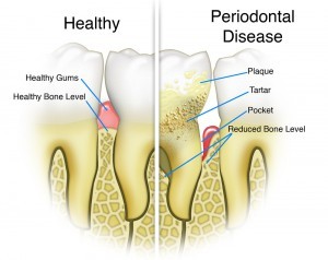 gum-disease-dentist-coconut-grove-fl-periodontal