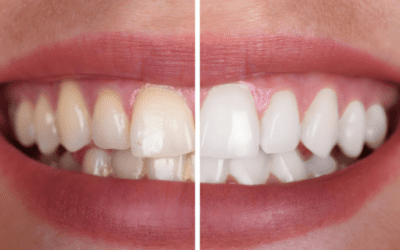 Whiter Teeth In A Flash!