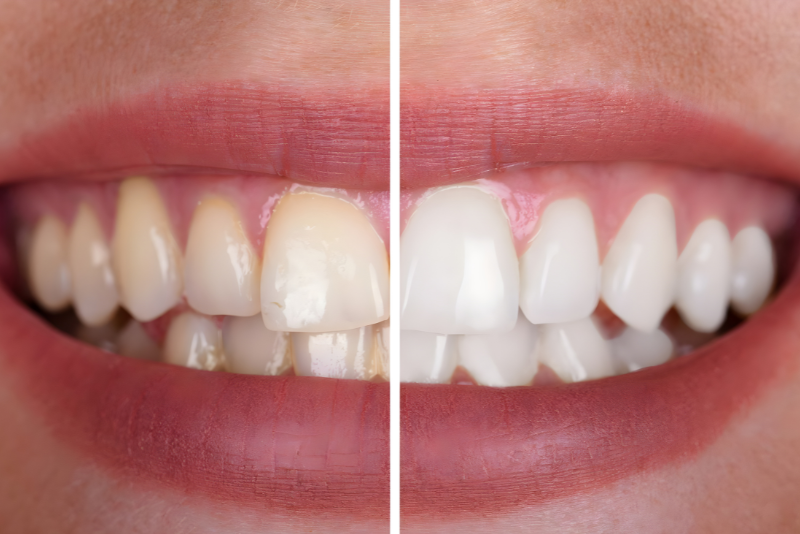 zoom-teeth-whitening-grove-smiles-dentistry-dr-rita-dargham